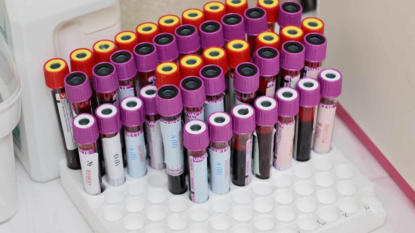 High Uric Acid Warning Signs Patients Should Not Ignore